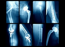 X-ray of steel hip replacement